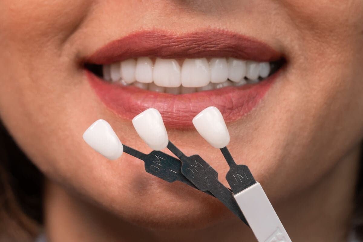 Veneers for Missing Teeth: Restore Your Perfect Smile